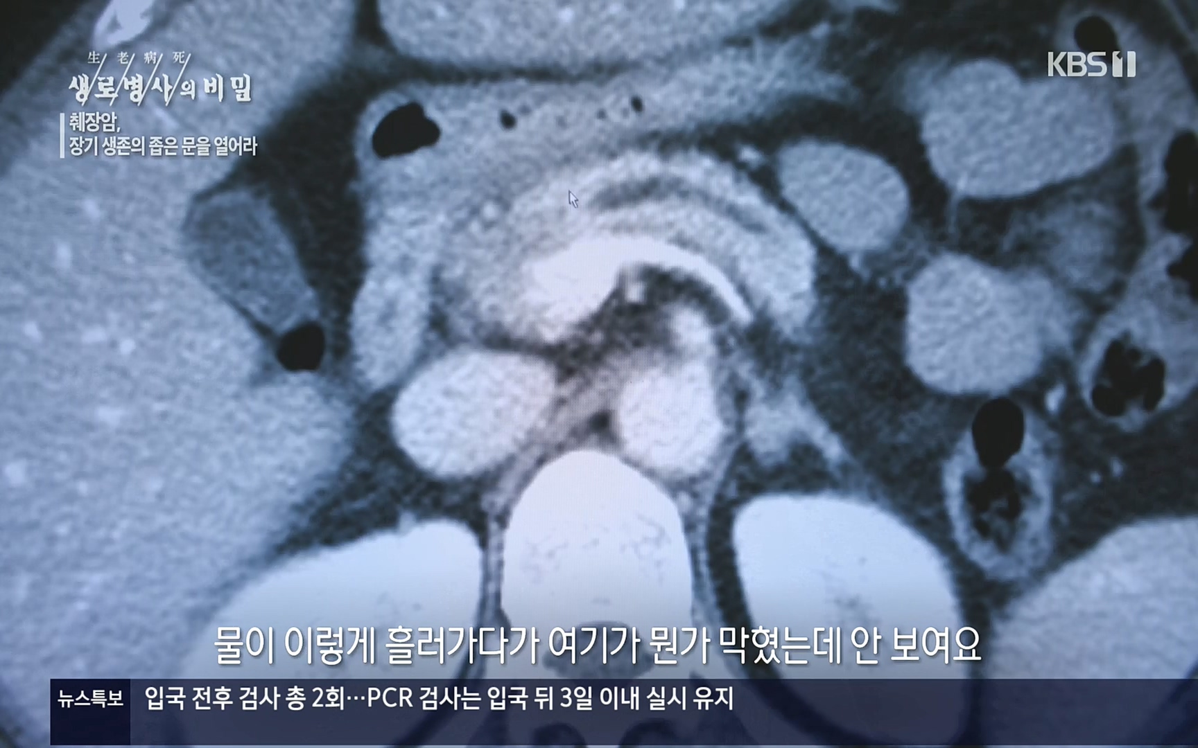생로병사의 비밀.E823.220622p.H264-F1RST.mp4_20220624_210525.400.jpg