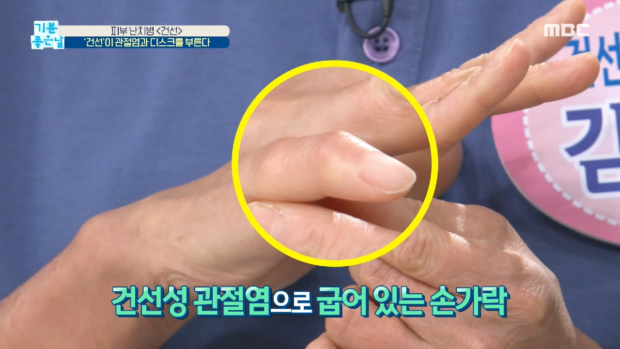  기분 좋은 날 피부 건선 가려움증 면역력 향상 황기/탱자/신사/보중익기차 효능 효과 햇빛 알레르기 김세아 피부 천연 보습제 비법 건선 원인 증상 치료 예방 합병증 관절염 우울증