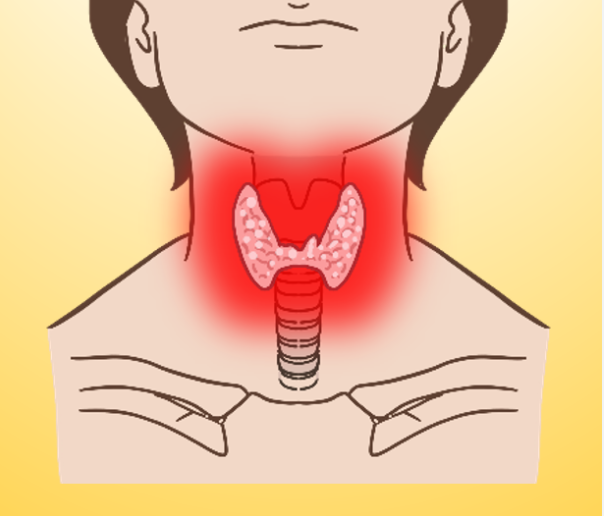 갑상선 항진증