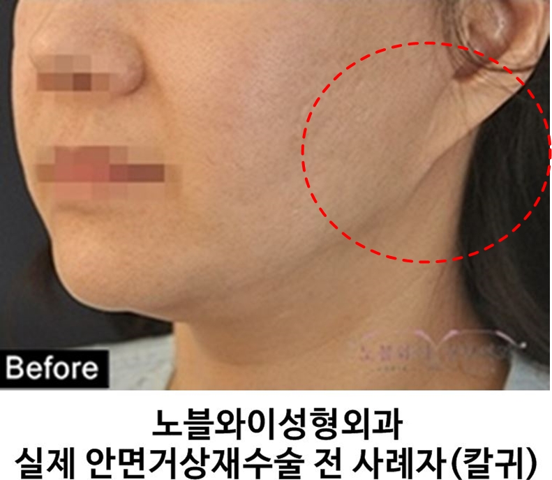  안면거상재수술 왜 귀가 내려오는거죠?