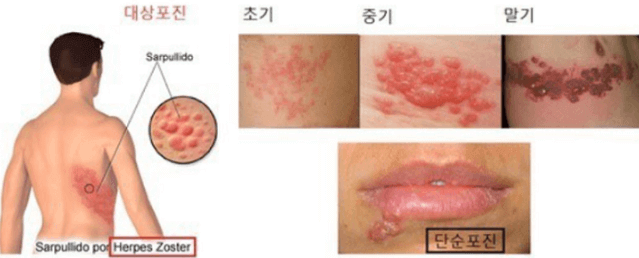대상포진-물집-단계