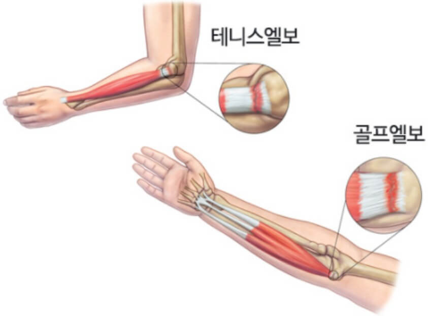  팔꿈치 원인 및 증상 7가지