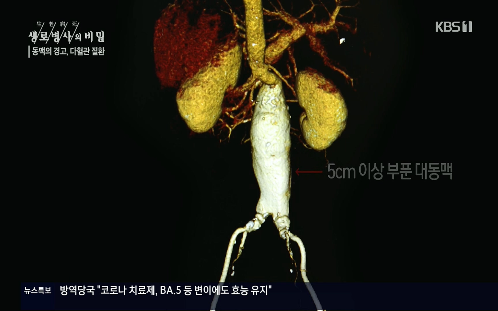 생로병사의 비밀.E831.220817p.H264-F1RST.mp4_20220822_185315.654.jpg
