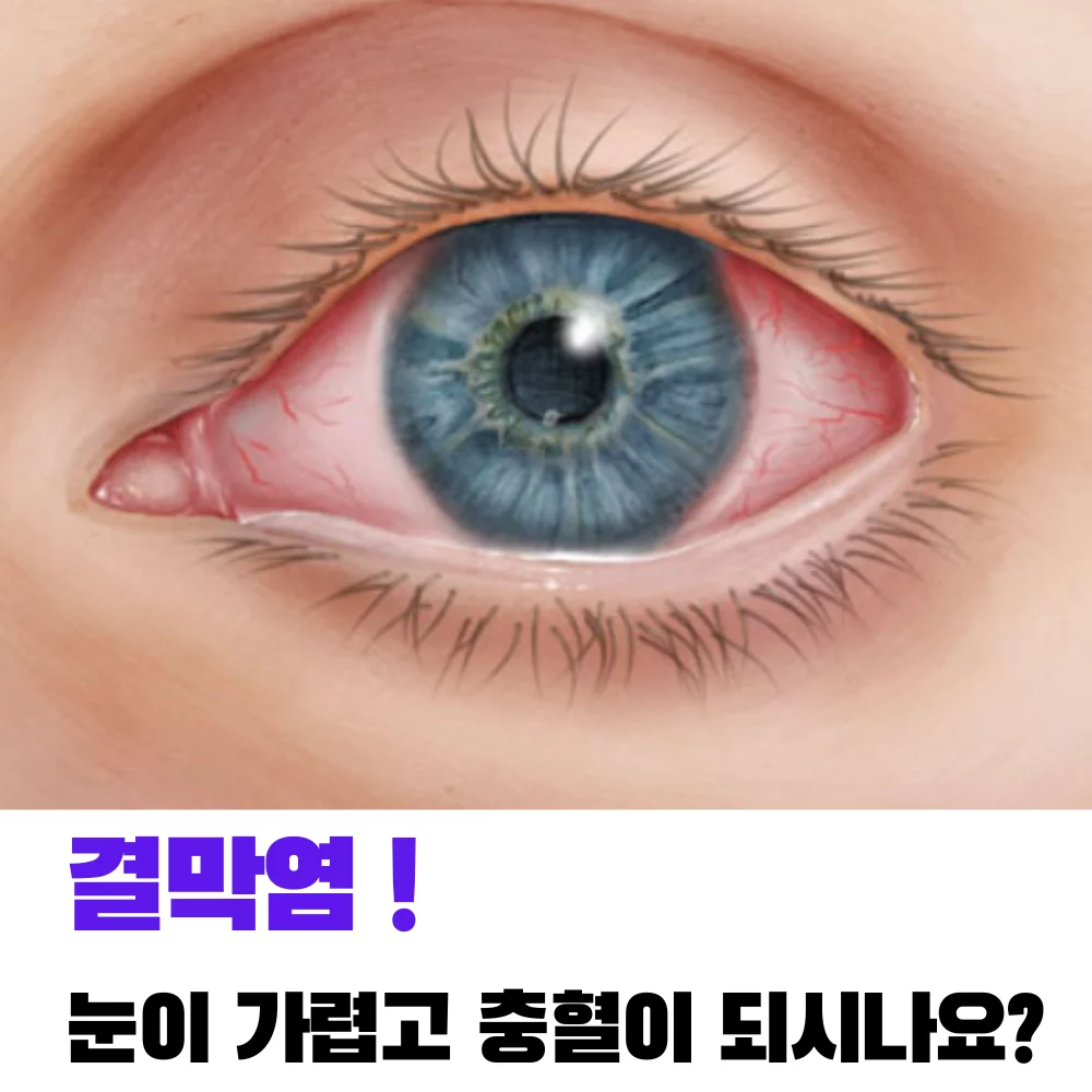 결막염-눈이-가렵고-충혈-되시나요