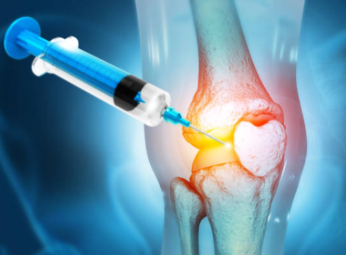 무릎에 물이 차는 증상 물이 찼을때 19