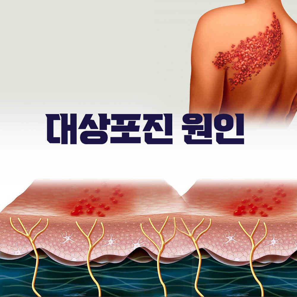 대상포진 원인