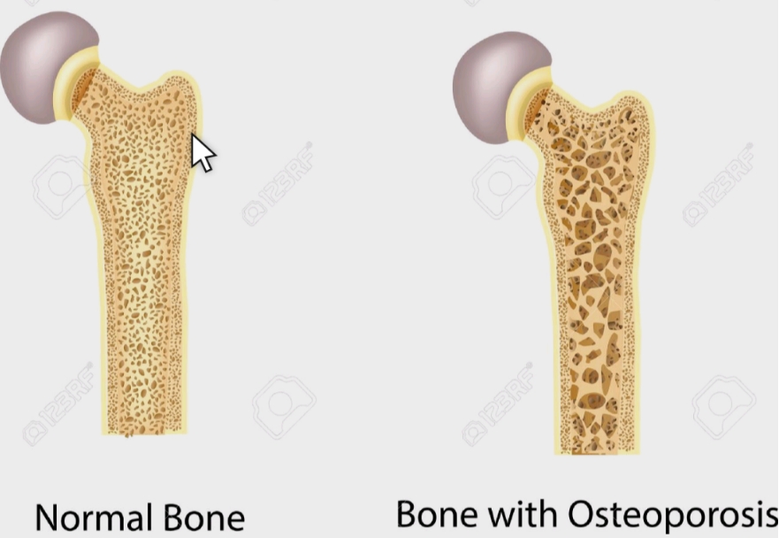 뼈 건강 설명