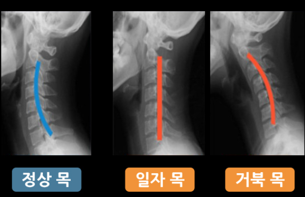일자목과 거북목