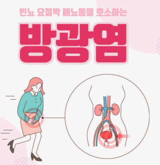 방광염