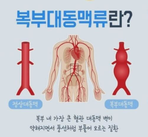 복부 대동맥류 증상과 원인 및 자가진단
