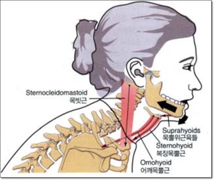 구부정한 자세로 인해서 근육의 단축과 머리와 턱의 변형이 나타나는 것을 표현한 그림