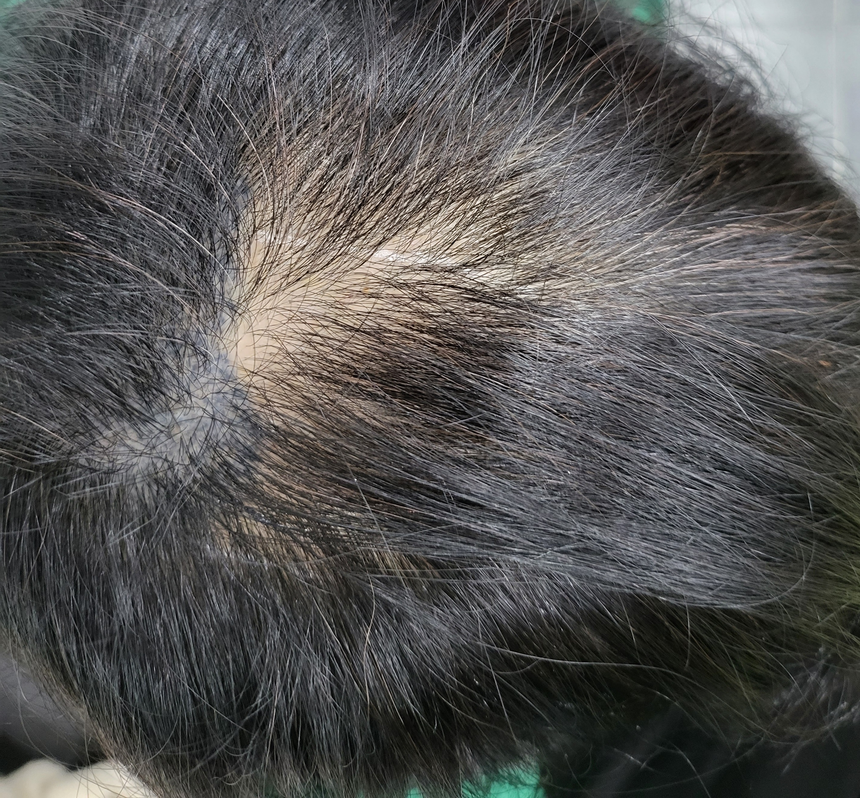  전주 두피문신제거 SMP문신부작용 지우기