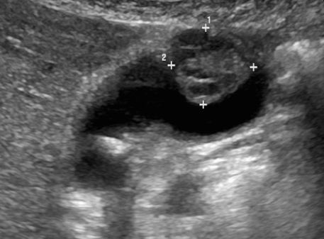 Gall bladder carcinoma (담낭암)