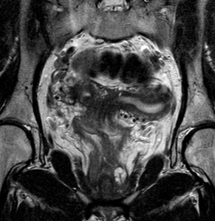 중복자궁의 MRI