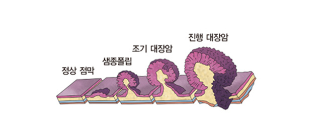 대장암-초기증상