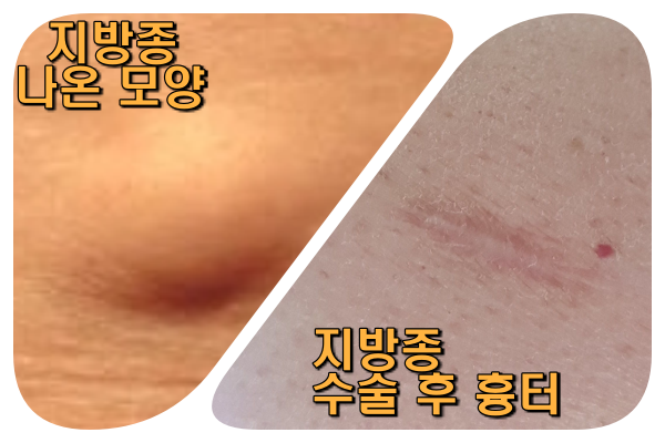  지방종, 지방덩어리 수술 후기
