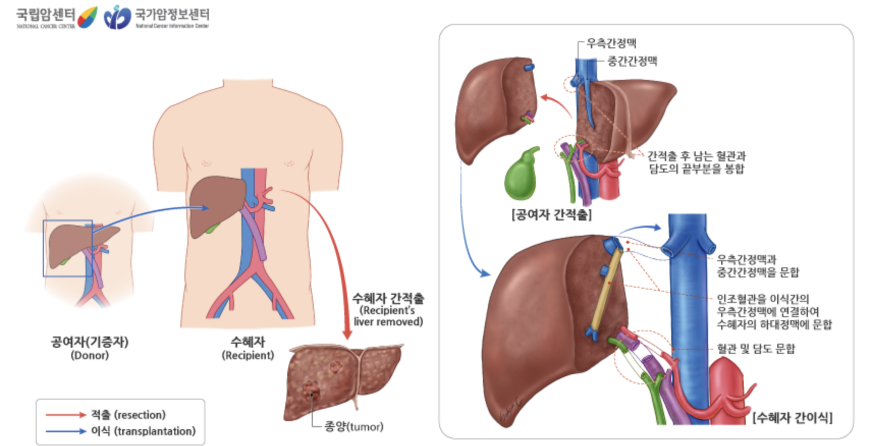 간암 : 간암 치료방법 및 치료종류