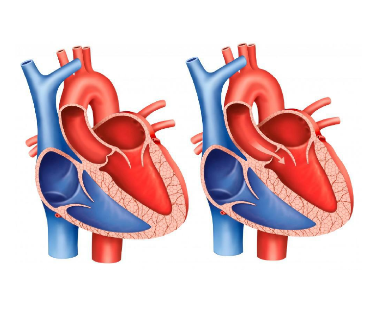  대동맥 협착(Aortic stenosis) : 대동맥 협착 원인, 대동맥 협착 가슴통증, 호흡곤란 대동맥 협착
