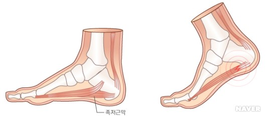 족저근막염