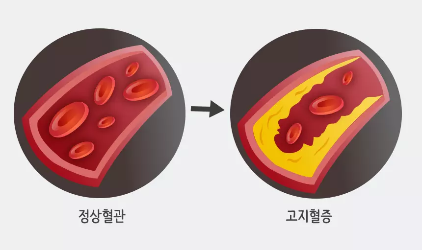 고지혈증 사진