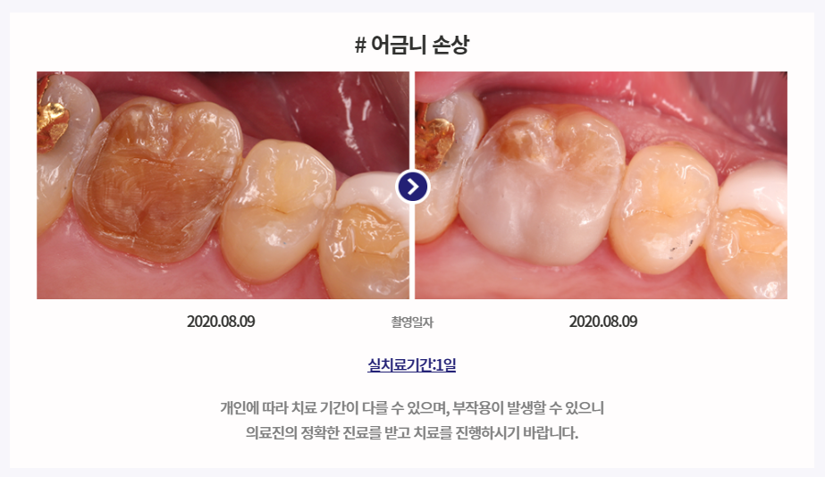 미니쉬 치과병원, 미니쉬 가격 아세요 (완벽정리)