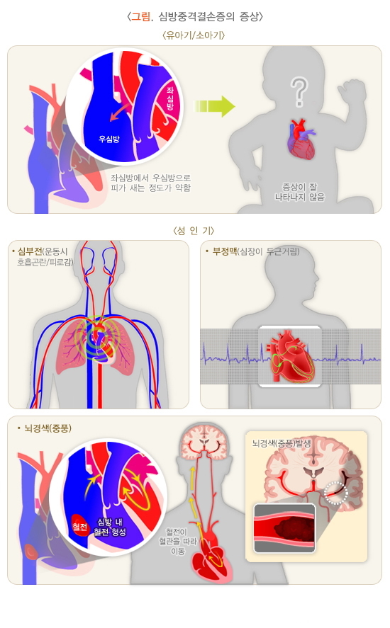  심방중격결손증