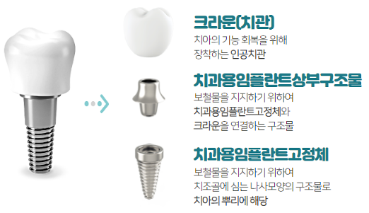 임플란트-구조