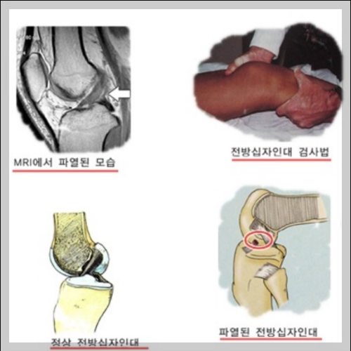 전방 십자인대 검사법