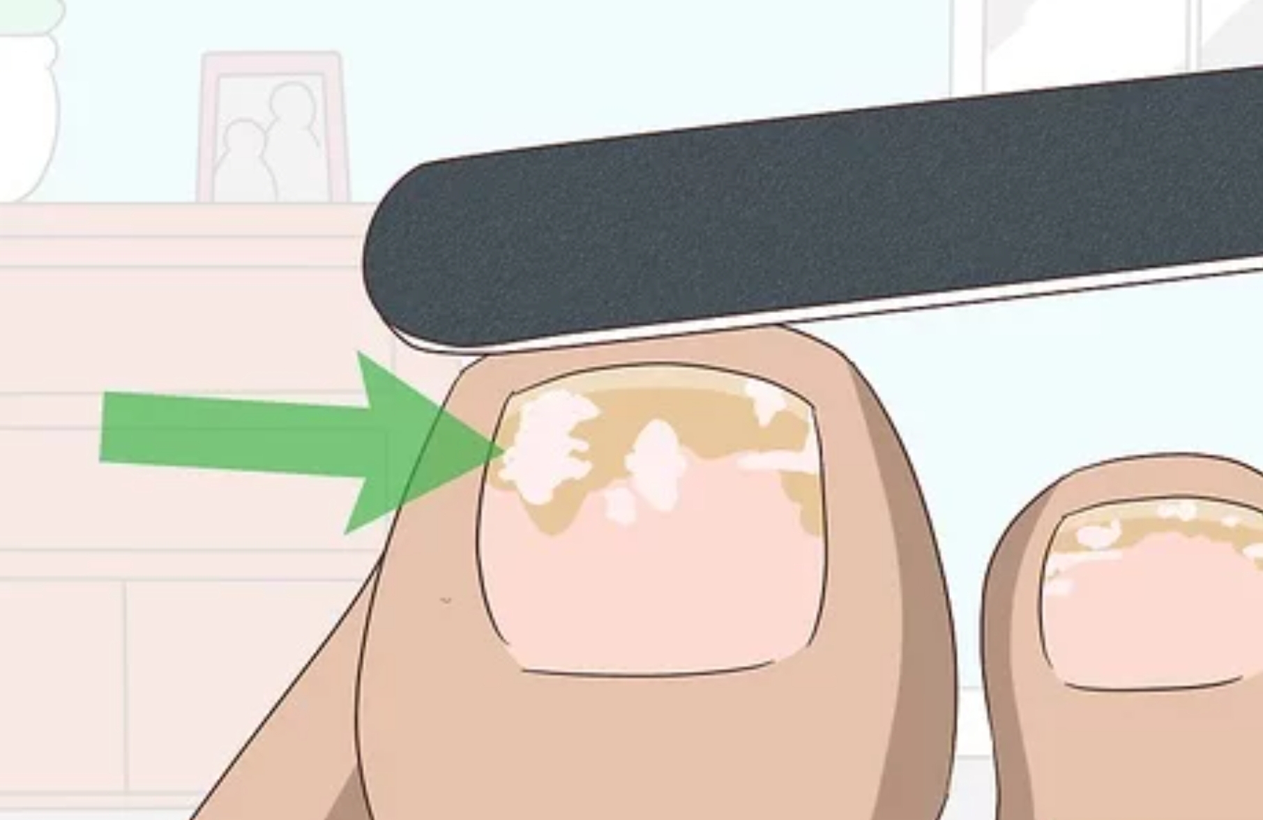  발톱 무좀(Onychomycosis):  가장 현실적인 치료 방법과 전망