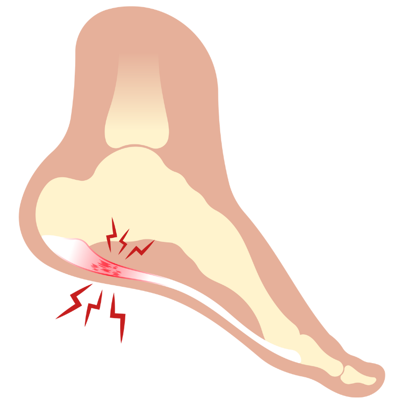 발바닥 통증의 원인