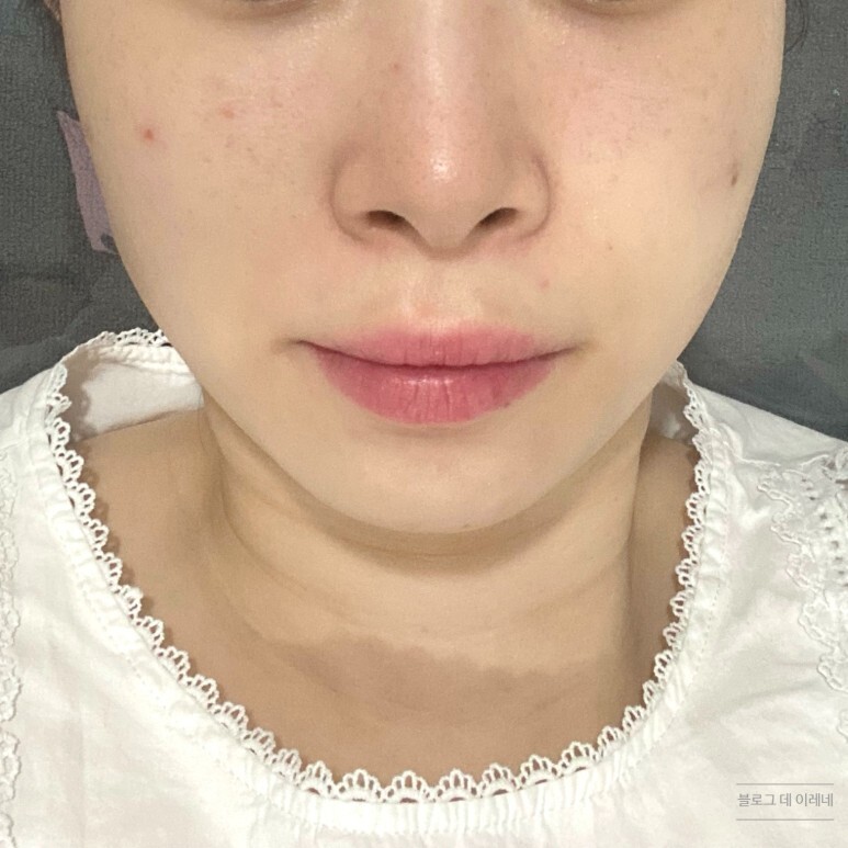  클라리티 레이저 후기, 전후사진+후회하는 이유