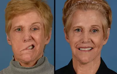 Bell&#39;s palsy-before-after2