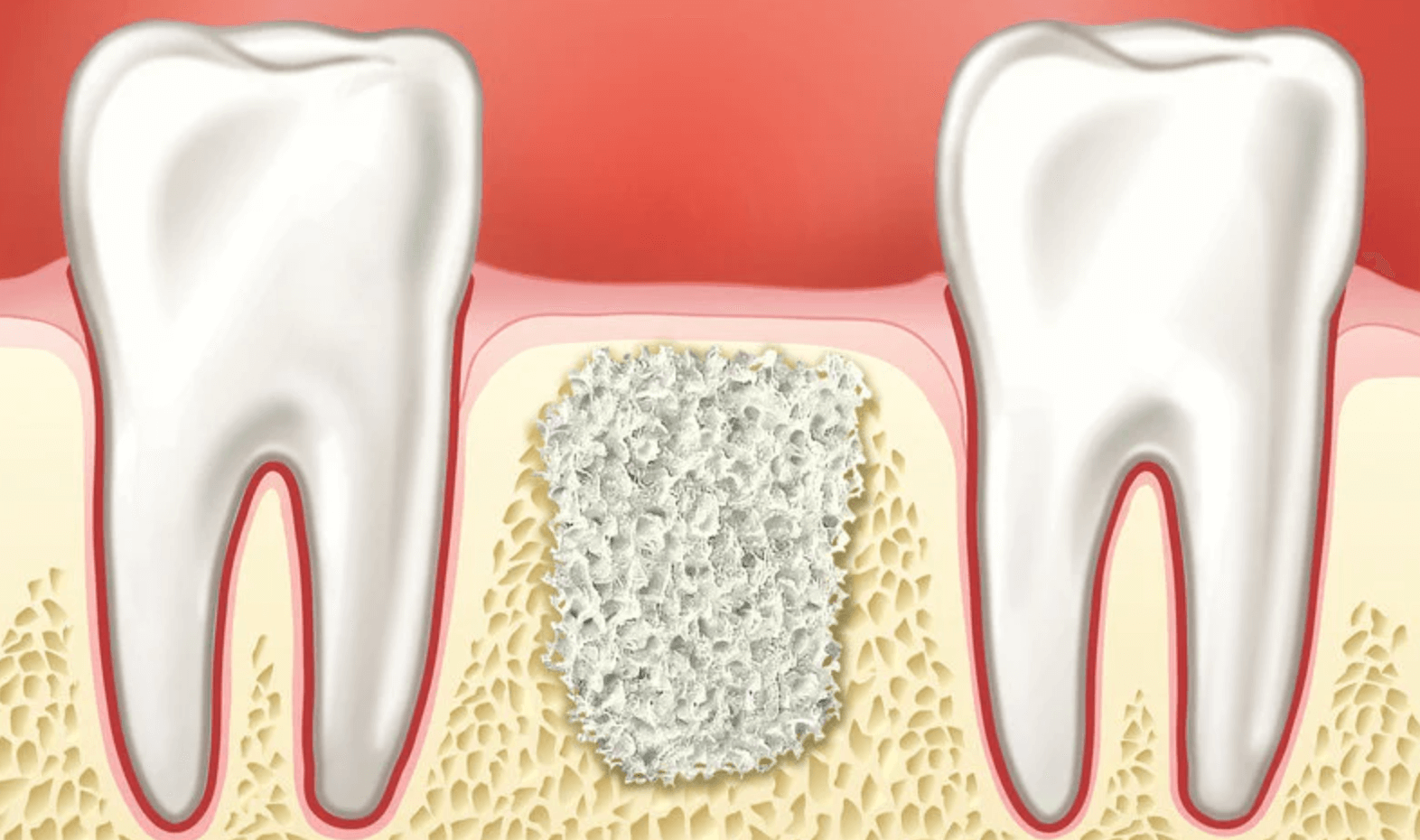 치조골-뼈이식