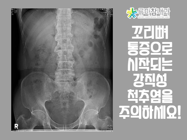 꼬리뼈 통증 병원 오랫동안 서 있거나 앉아 있는 것이 힘들어요! 4