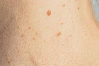 몸에 점이 계속 생기는 이유 원인부터 예방법까지 한눈에_2
