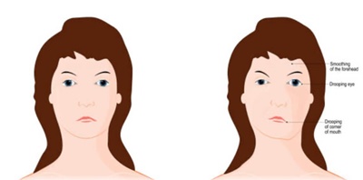 안면거상술 후 나타날 수 있는 부작용을 보여주는 그림