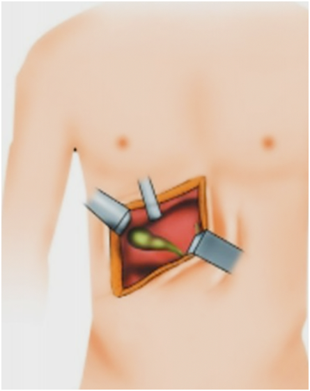 급성담낭염, 개복 담낭절제술 (Open Cholecystectomy)