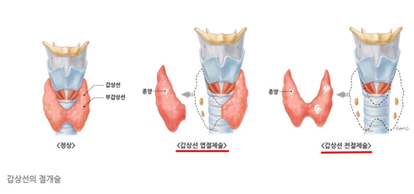 갑상선 수술