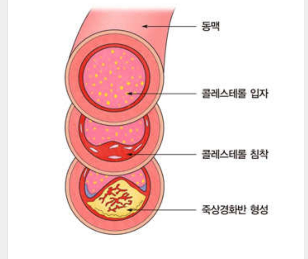 콜레스테롤동맥경화