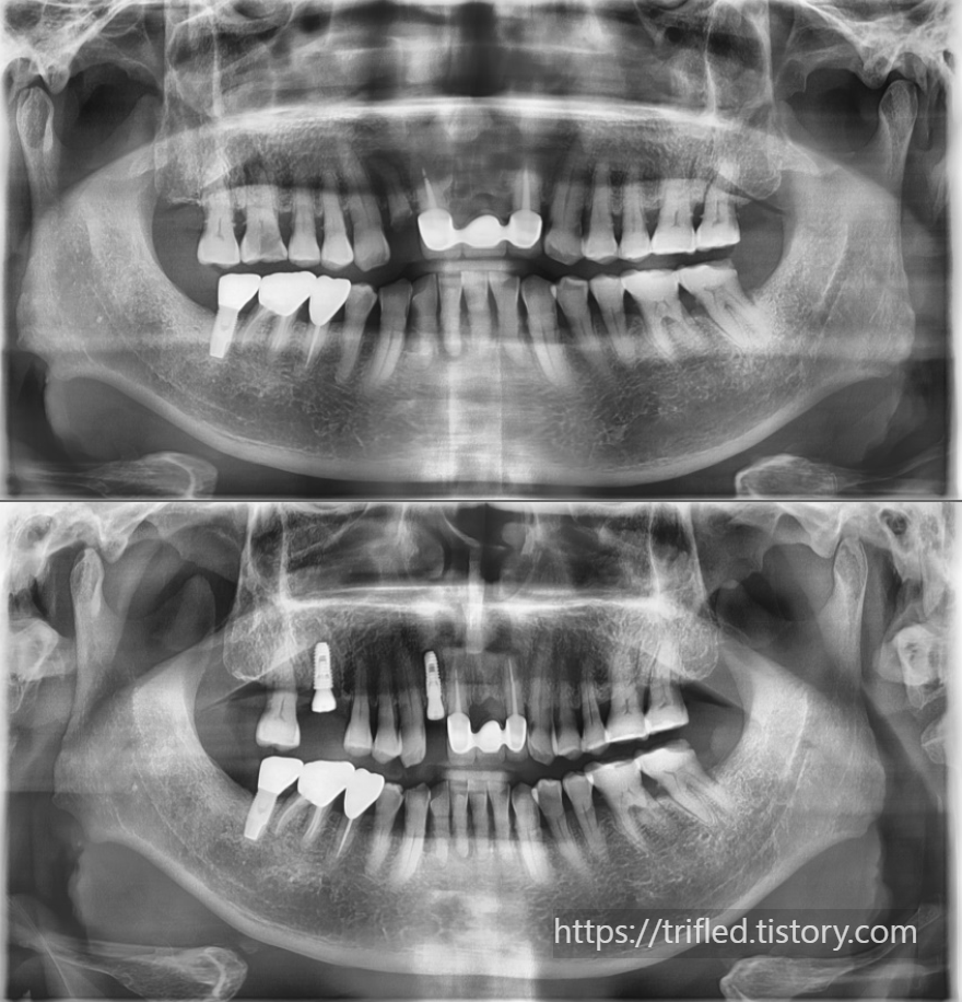 치아보험 청구할 때에는 치료 전후 엑스레이 사진을 제출해야 함