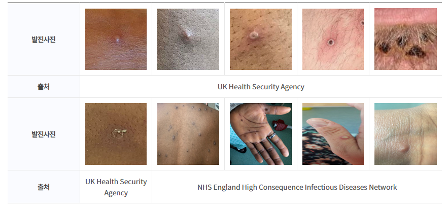 Mpox(monkeypox) 발진 사진(질병관리본부)