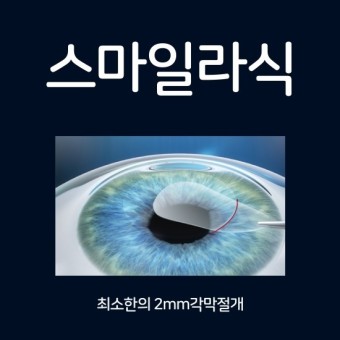  스마일라식은 어떤 방법 일까요?