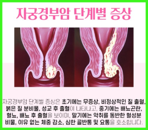 자궁 경부암 원인 증상 치료 및 예후 재발과 사망률