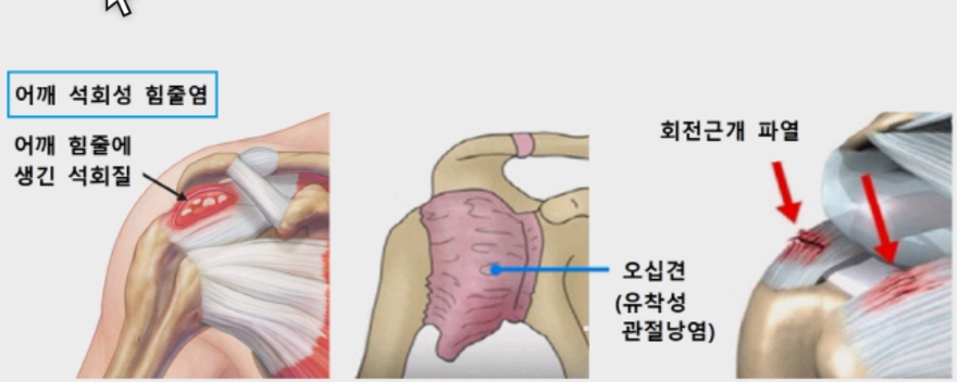 어깨통증 5
