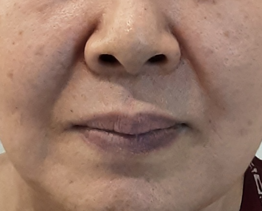  심술보 리프팅, 처진 피부를 되돌릴 수 없을까?
