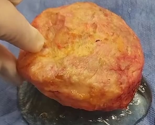 이런! 성형 시술 의사가 10년 후 고객의 유방 보형물을 꺼냈더니..VIDEO: TikTok surgeon removes woman&#39;s 35-year-old breast implants