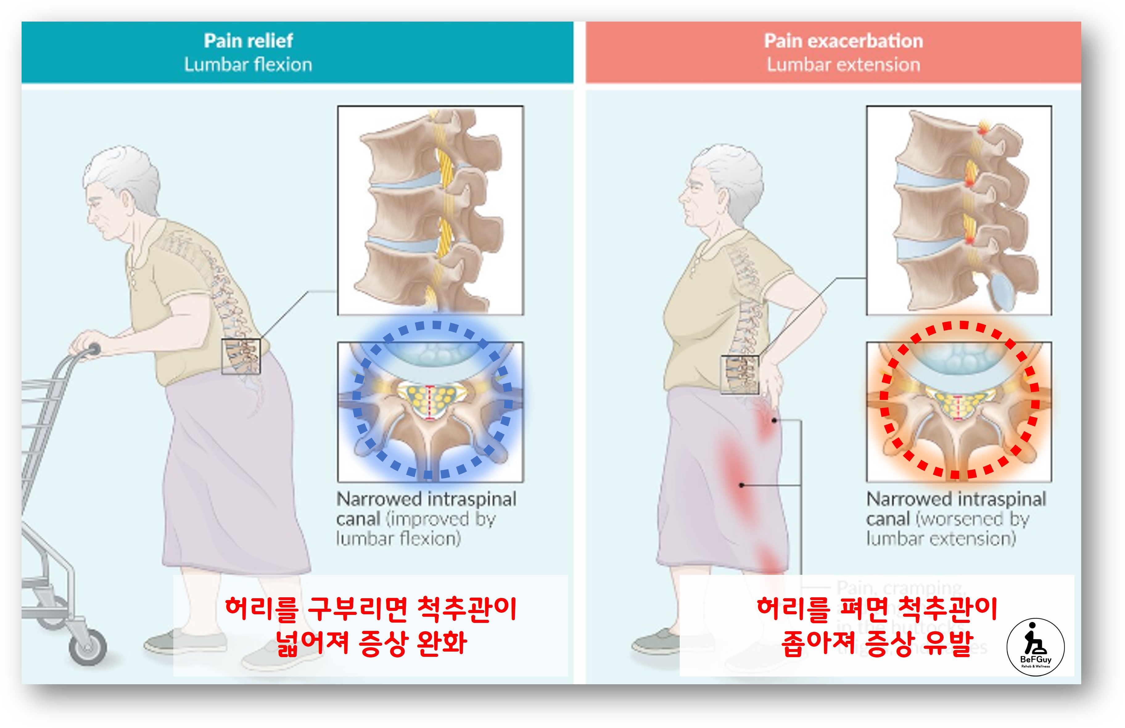 척추관 협착증 증상