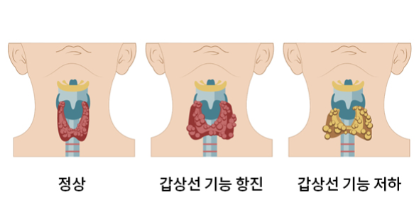 갑상선 기능 이상 증상