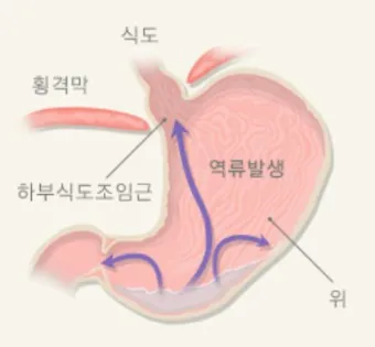 식도염에 좋은 음식 안좋은 음식_2