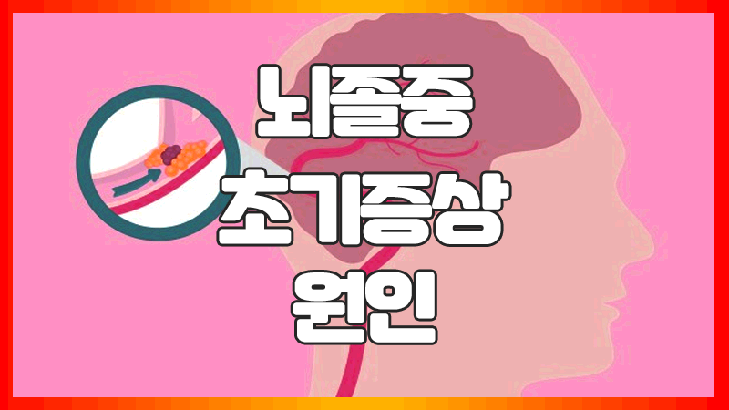  뇌졸중 전조증상 : 초기증상, 예방
